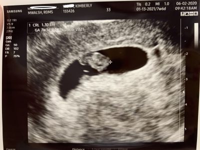 7 Week Ultrasound Photo, 7 Weeks Pregnant Ultrasound Image 7 Week Ultrasound Photo, 7 Weeks Pregnant Ultrasound Image